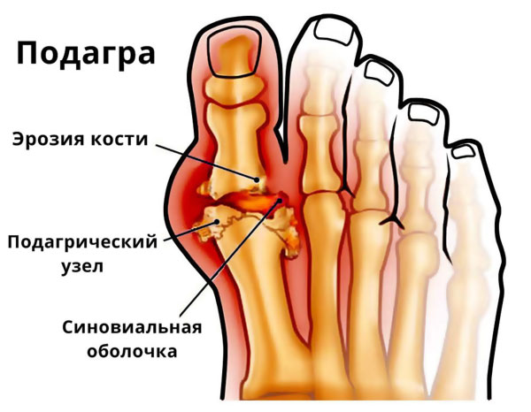 Подагра