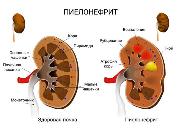 Диета при пиелонефрите почек, разрешенные и запрещенные продукты