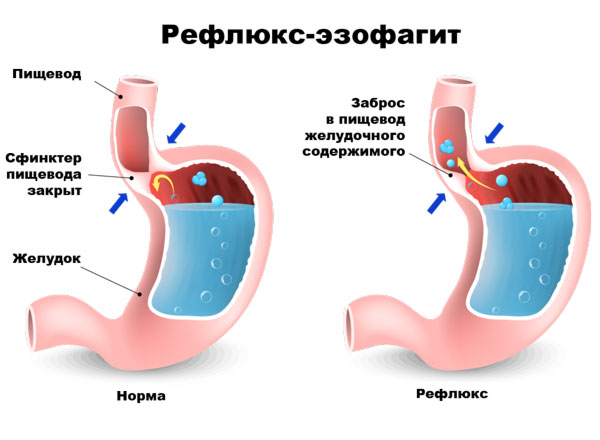 Рефлюкс эзофагит