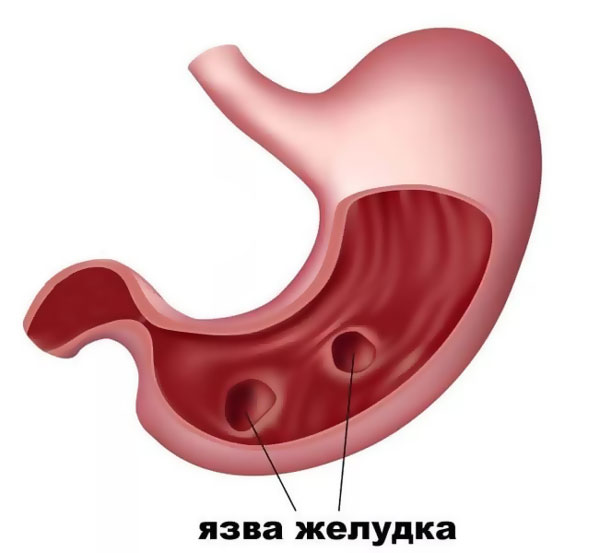 Язва-желудка
