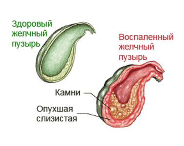 Желчный пузырь воспаление