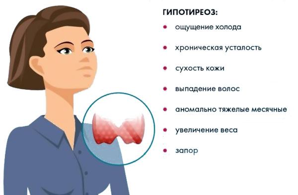 гипотиреоз