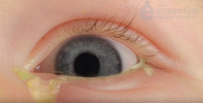 Закисший глазик у ребенка