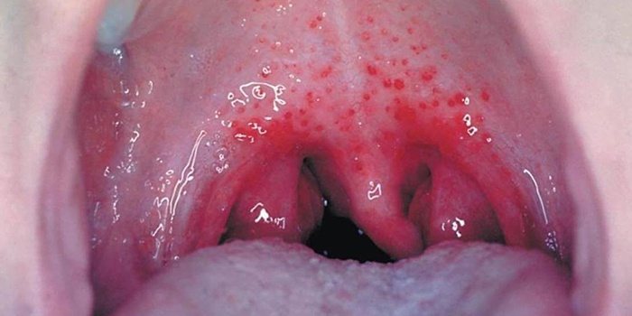 Как выглядит ангина