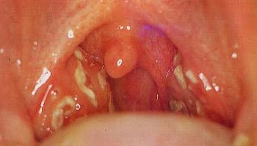 Гнойная ангина у ребенка