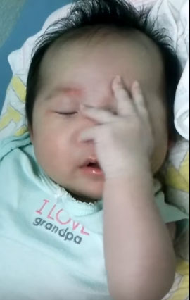 грудничок царапает себе лицо