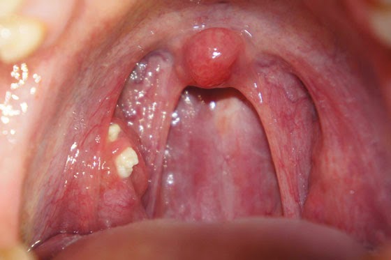 Острый тонзиллит у малыша