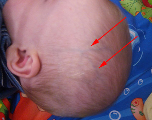 Вены на голове у Димы