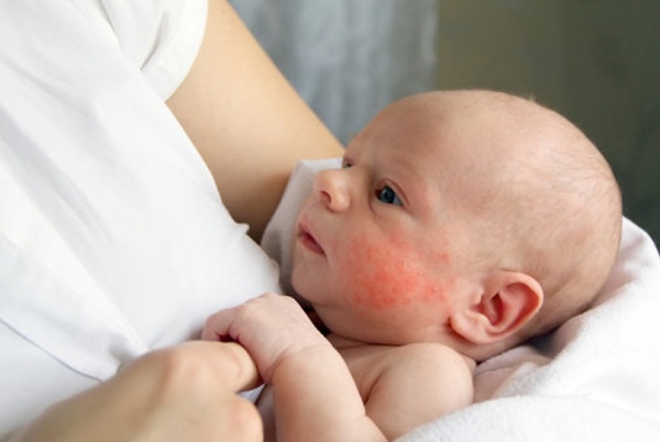 Ребенок с красными щечками