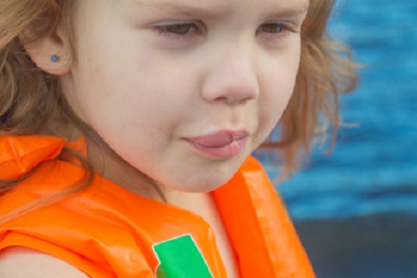 Девочка с припухшей верхней губой