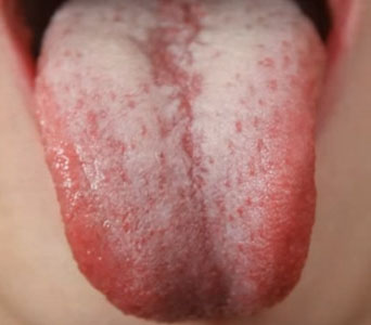 Белый налет на языке