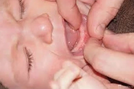 Красные десна у грудничков