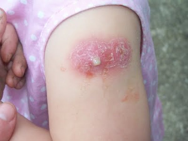 гной от БЦЖ