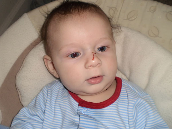 Грудничок ударился носом