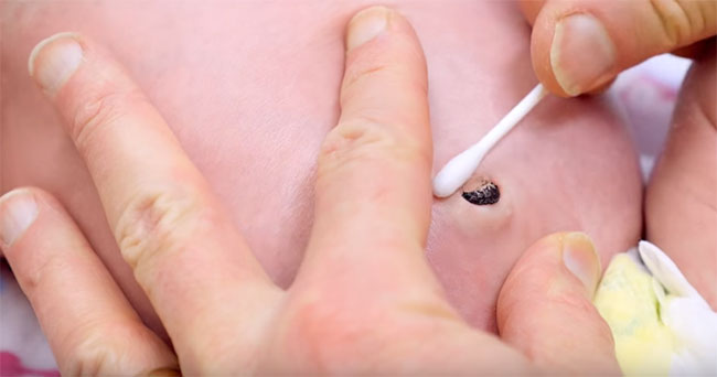 Обрабатывание пупочной ранки