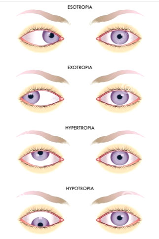 Типы косоглазия