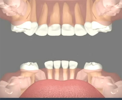 Верхние клыки