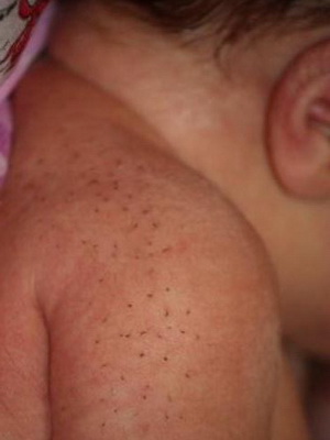 Волосики на теле малыша