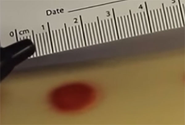 Манту большого размера замеряют специальной линейкой