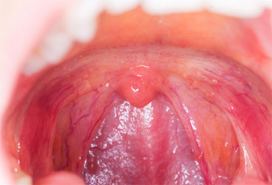 Красное горло