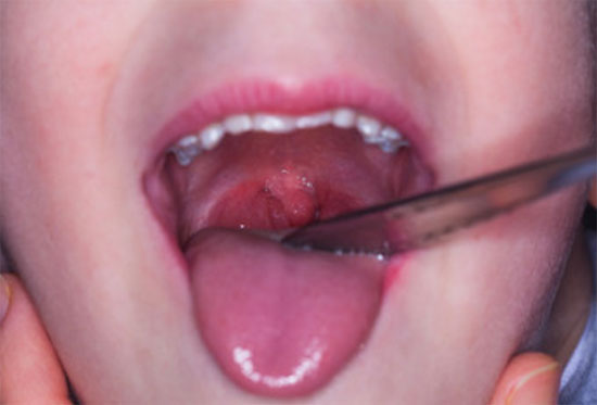 Очень красное горло