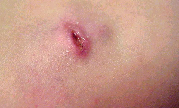 Реакция на прививку бцж