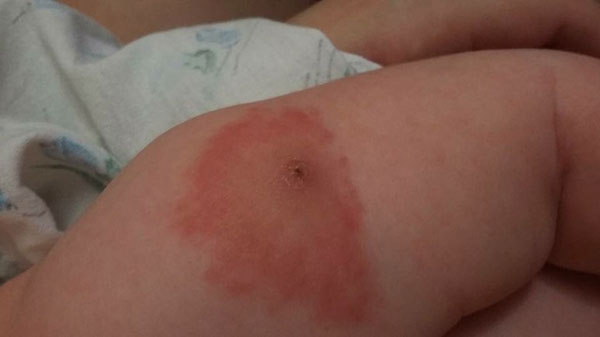 Гноится БЦЖ