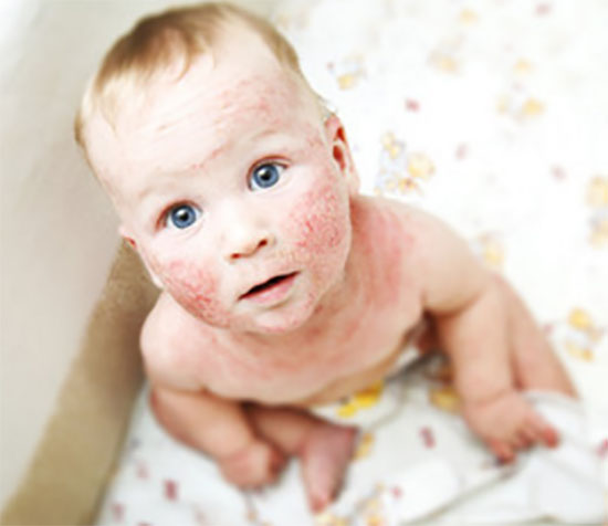 У ребенка на лице и шеи явные признаки дерматита