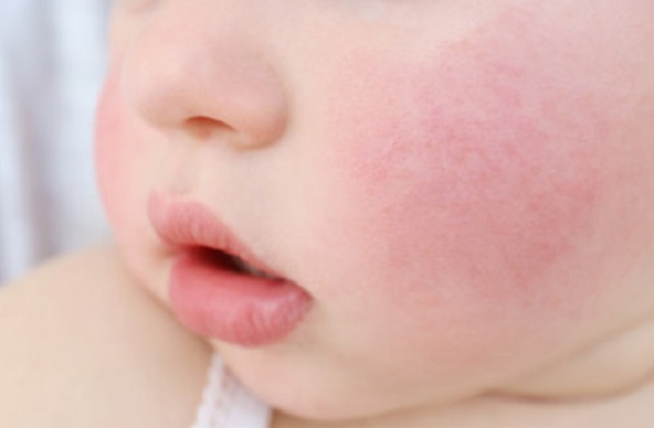 Щечки с краснатой