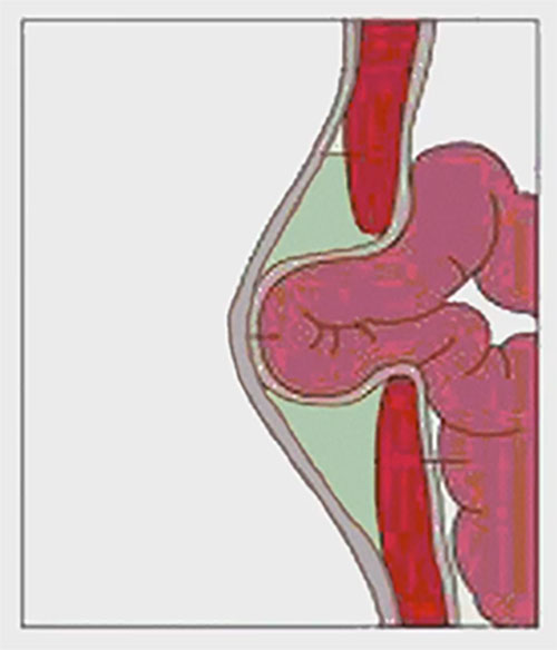 Выпирание участка кишки. Схема