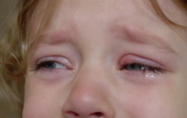 У девочки припухший глаз