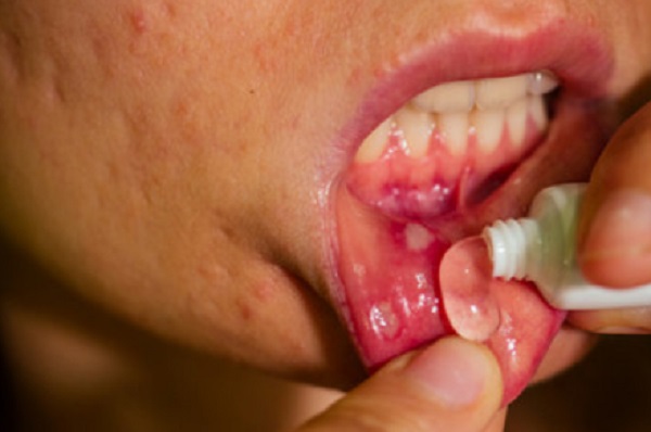 Нанесение геля на язвочки