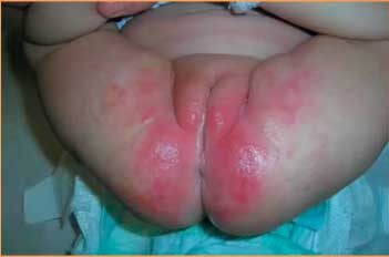 Вторая степень опрелости