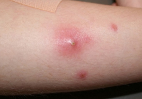 Фурункул на руке ребенка