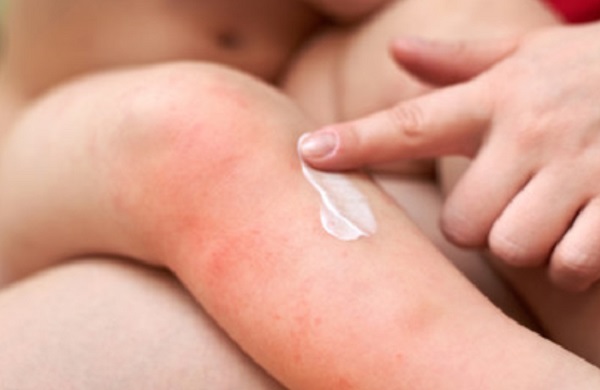 Мама мажет ребенку ожог мазью