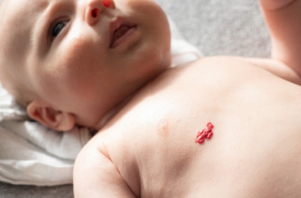Земляничная гемангиома на теле ребенка