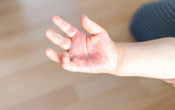 Ожог на ручке ребенка