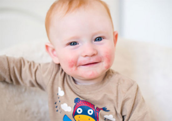 Ребенок с сыпью на щеках, над губой и на бороде