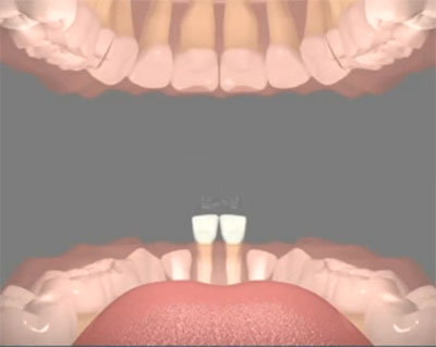 Нижние резцы