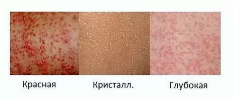 Потницы разного рода