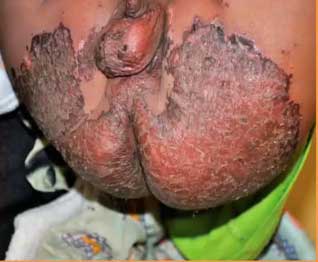 Третья степень опрелостей