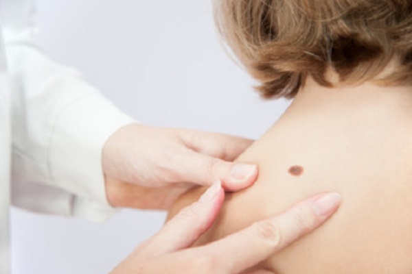 Доктор осматривает родинку