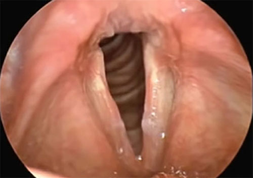 Снимок воспалённых голосовых связок