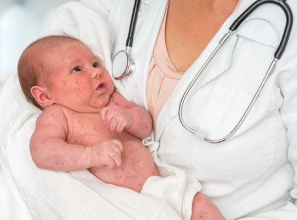 Грудной ребенок с сыпью на теле на руках у доктора