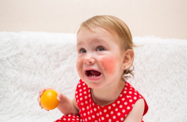 У девочки сильный диатез на щеках. В руке она держит апельсин