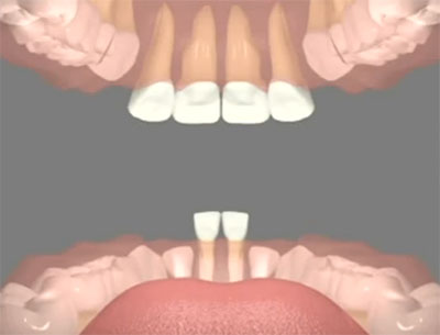 Верхние боковые резцы