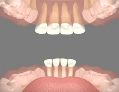Нижние боковые резцы