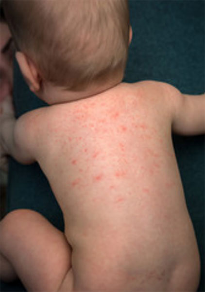 У ребенка сыпь на спине