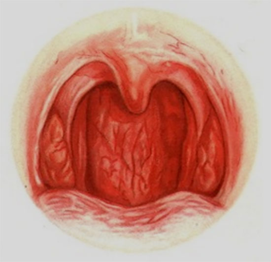 Картинка с изображением острой формы фарингита
