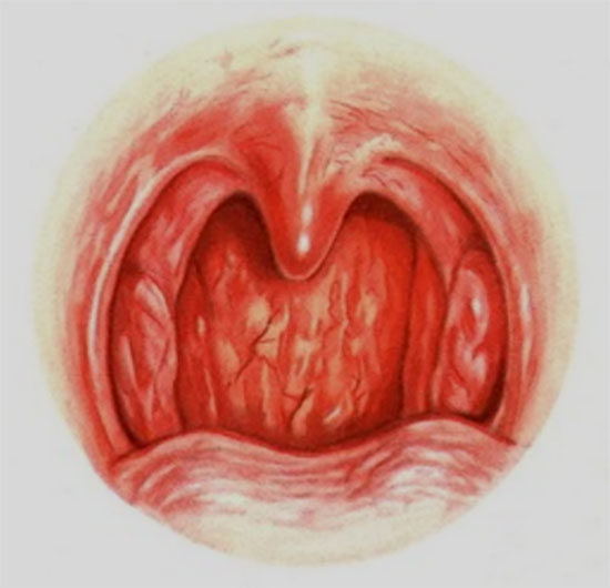 Картинка с изображением хронической формы фарингита